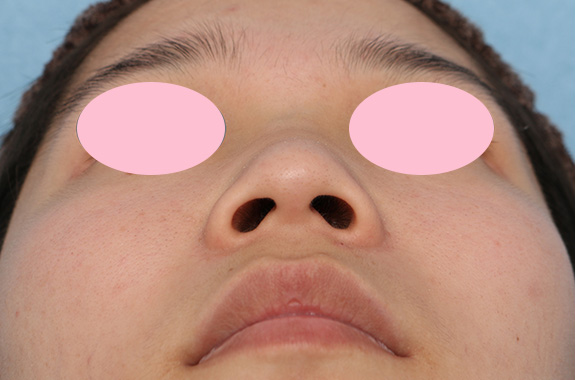 症例写真,鼻を高くするヒアルロン酸注射の症例写真,Before,ba_ryubi2035_b02.jpg