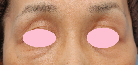 くぼみ目修正（ヒアルロン酸注射）,上まぶたのくぼみ目をヒアルロン酸で治療した症例,After,ba_kubomi005_b01.jpg