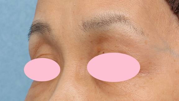くぼみ目修正（ヒアルロン酸注射）,上まぶたのくぼみ目をヒアルロン酸で治療した症例,After,ba_kubomi005_b02.jpg