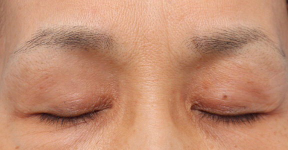くぼみ目修正（ヒアルロン酸注射）,上まぶたのくぼみ目をヒアルロン酸で治療した症例,After,ba_kubomi005_b03.jpg