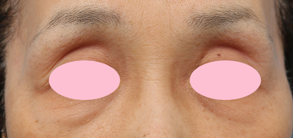 くぼみ目修正（ヒアルロン酸注射）,上まぶたのくぼみ目をヒアルロン酸で治療した症例,Before,ba_kubomi005_b01.jpg