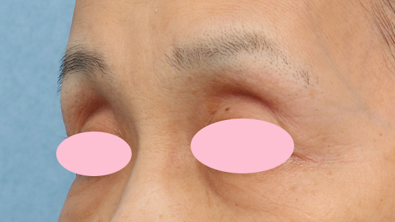 くぼみ目修正（ヒアルロン酸注射）,上まぶたのくぼみ目をヒアルロン酸で治療した症例,Before,ba_kubomi005_b02.jpg