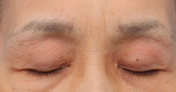 くぼみ目修正（ヒアルロン酸注射）,上まぶたのくぼみ目をヒアルロン酸で治療した症例,Before,ba_kubomi005_b03.jpg