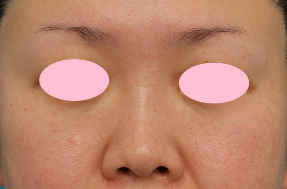 隆鼻注射（ヒアルロン酸注射）,ヒアルロン酸による隆鼻術の症例写真,After（1ヶ月後）,ba_ryubi2032_b01.jpg
