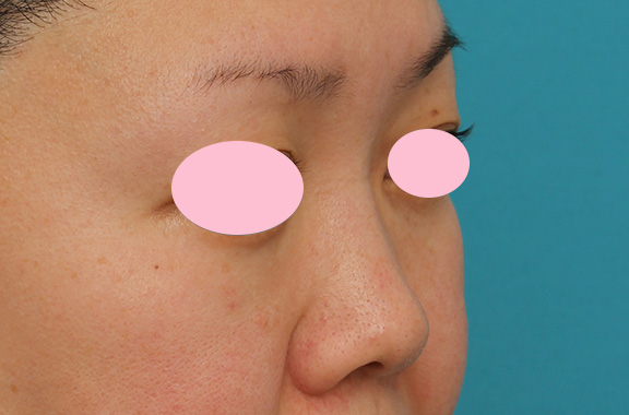 隆鼻注射（ヒアルロン酸注射）,ヒアルロン酸による隆鼻術の症例写真,After（1ヶ月後）,ba_ryubi2032_b02.jpg