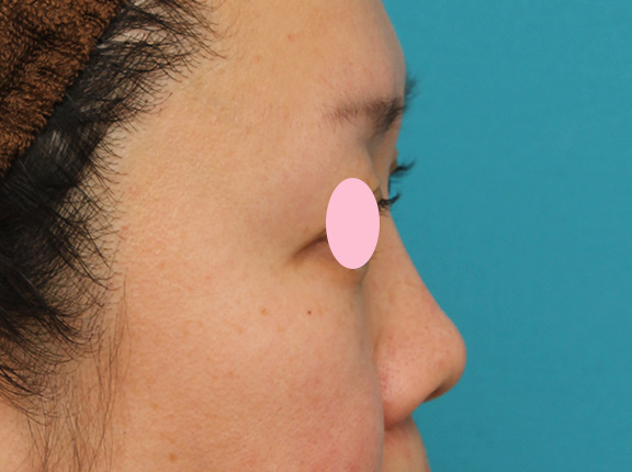 隆鼻注射（ヒアルロン酸注射）,ヒアルロン酸による隆鼻術の症例写真,After（1ヶ月後）,ba_ryubi2032_b03.jpg