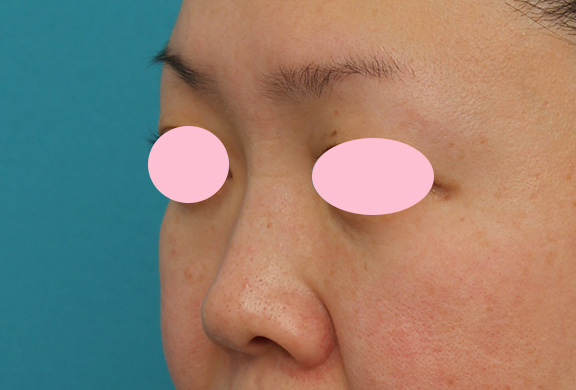 隆鼻注射（ヒアルロン酸注射）,ヒアルロン酸による隆鼻術の症例写真,After（1ヶ月後）,ba_ryubi2032_b04.jpg