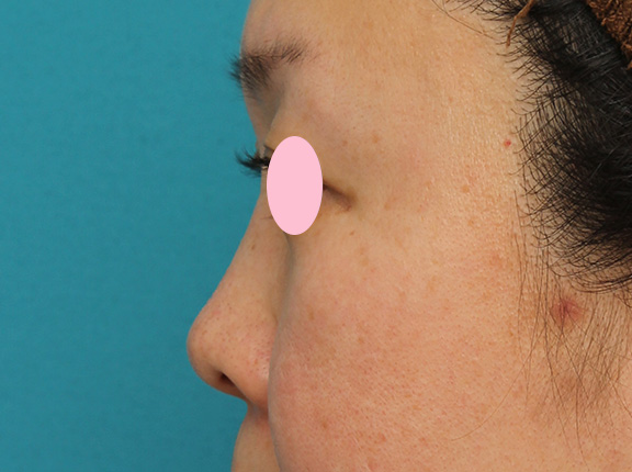 隆鼻注射（ヒアルロン酸注射）,ヒアルロン酸による隆鼻術の症例写真,After（1ヶ月後）,ba_ryubi2032_b05.jpg