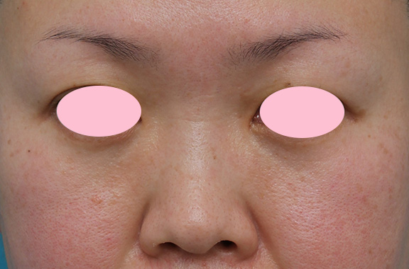 隆鼻注射（ヒアルロン酸注射）,ヒアルロン酸による隆鼻術の症例写真,Before,ba_ryubi2032_b01.jpg