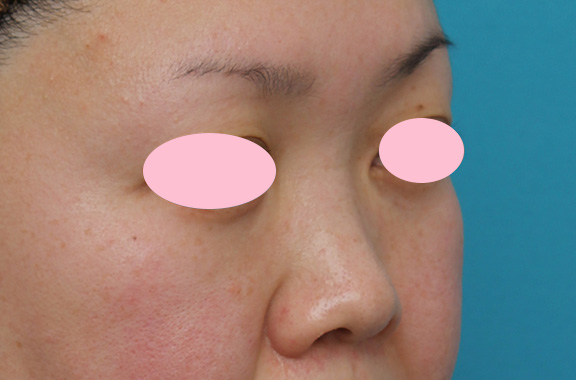 隆鼻注射（ヒアルロン酸注射）,ヒアルロン酸による隆鼻術の症例写真,Before,ba_ryubi2032_b02.jpg