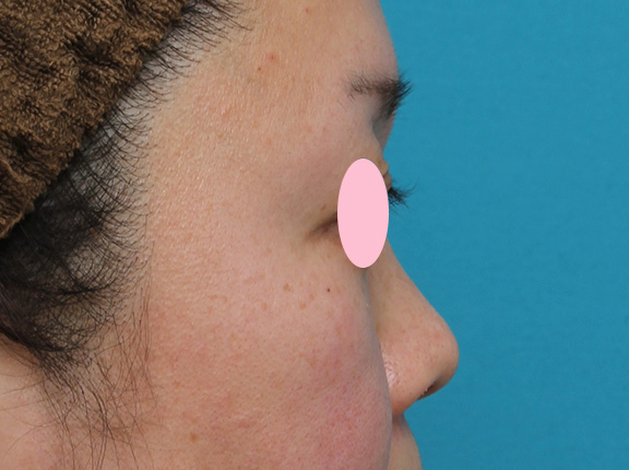 隆鼻注射（ヒアルロン酸注射）,ヒアルロン酸による隆鼻術の症例写真,Before,ba_ryubi2032_b03.jpg