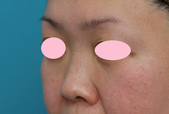 隆鼻注射（ヒアルロン酸注射）,ヒアルロン酸による隆鼻術の症例写真,Before,ba_ryubi2032_b04.jpg