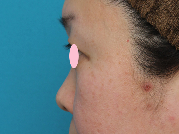 隆鼻注射（ヒアルロン酸注射）,ヒアルロン酸による隆鼻術の症例写真,Before,ba_ryubi2032_b05.jpg