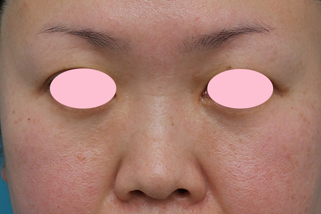 隆鼻注射（ヒアルロン酸注射）,ヒアルロン酸による隆鼻術の症例写真,手術前,mainpic_ryubi2032a.jpg