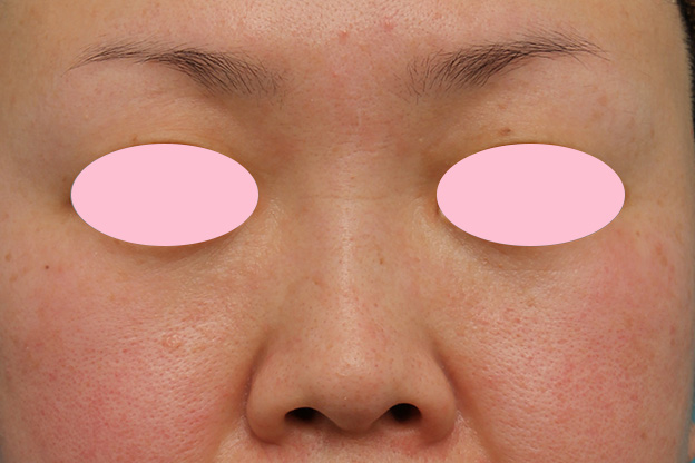隆鼻注射（ヒアルロン酸注射）,ヒアルロン酸による隆鼻術の症例写真,1週間後,mainpic_ryubi2032b.jpg