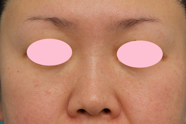 隆鼻注射（ヒアルロン酸注射）,ヒアルロン酸による隆鼻術の症例写真,1ヶ月後,mainpic_ryubi2032c.jpg