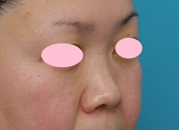 隆鼻注射（ヒアルロン酸注射）,ヒアルロン酸による隆鼻術の症例写真,手術前,mainpic_ryubi2032d.jpg