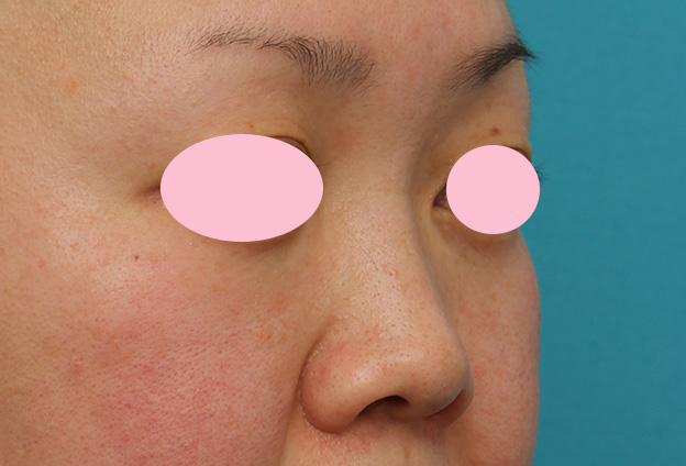 隆鼻注射（ヒアルロン酸注射）,ヒアルロン酸による隆鼻術の症例写真,1週間後,mainpic_ryubi2032e.jpg