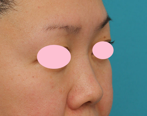 隆鼻注射（ヒアルロン酸注射）,ヒアルロン酸による隆鼻術の症例写真,1ヶ月後,mainpic_ryubi2032f.jpg