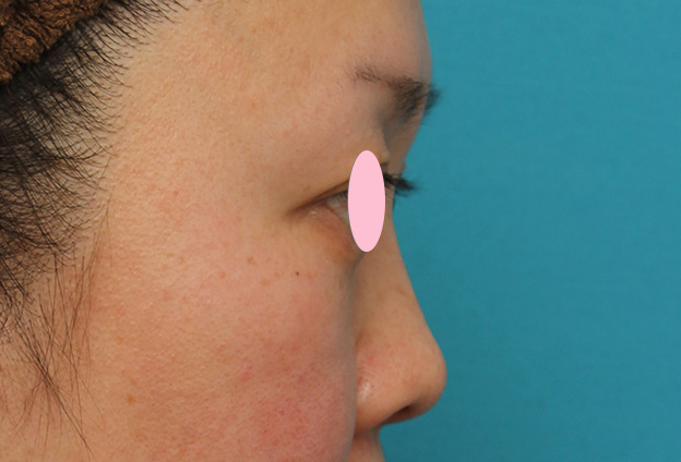 隆鼻注射（ヒアルロン酸注射）,ヒアルロン酸による隆鼻術の症例写真,1週間後,mainpic_ryubi2032h.jpg