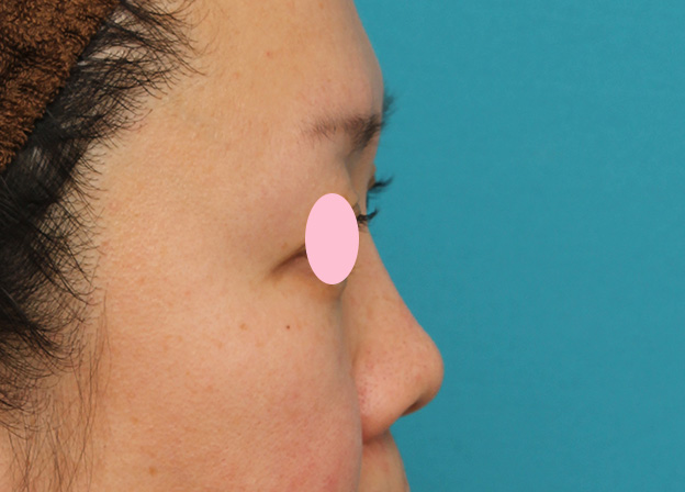 隆鼻注射（ヒアルロン酸注射）,ヒアルロン酸による隆鼻術の症例写真,1ヶ月後,mainpic_ryubi2032i.jpg