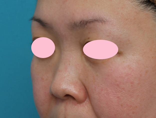 症例写真,ヒアルロン酸による隆鼻術の症例写真,手術前,mainpic_ryubi2032j.jpg
