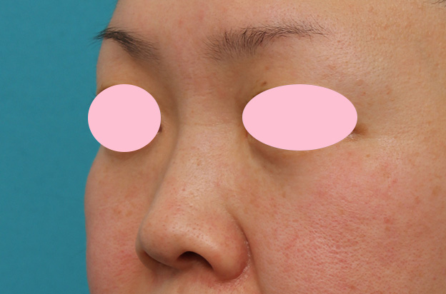 隆鼻注射（ヒアルロン酸注射）,ヒアルロン酸による隆鼻術の症例写真,1週間後,mainpic_ryubi2032k.jpg