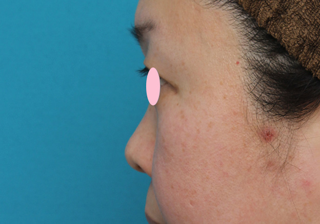 隆鼻注射（ヒアルロン酸注射）,ヒアルロン酸による隆鼻術の症例写真,手術前,mainpic_ryubi2032m.jpg