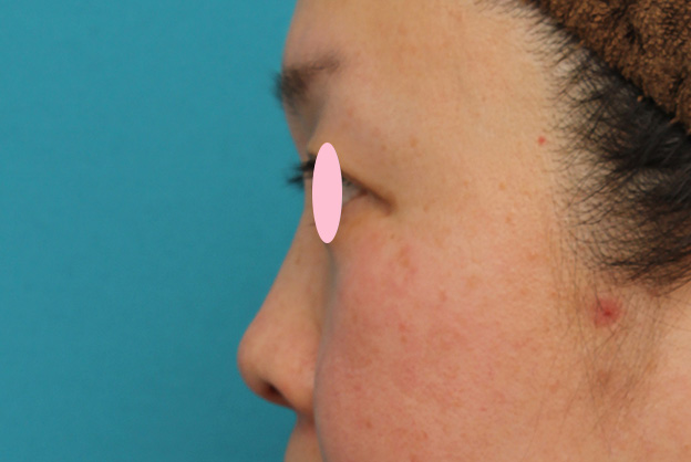 隆鼻注射（ヒアルロン酸注射）,ヒアルロン酸による隆鼻術の症例写真,1週間後,mainpic_ryubi2032n.jpg