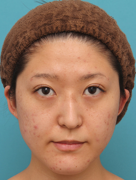 バッカルファット除去で小顔になった20代女性の症例写真,After（6ヶ月後）,ba_buccalfat017_a01.jpg