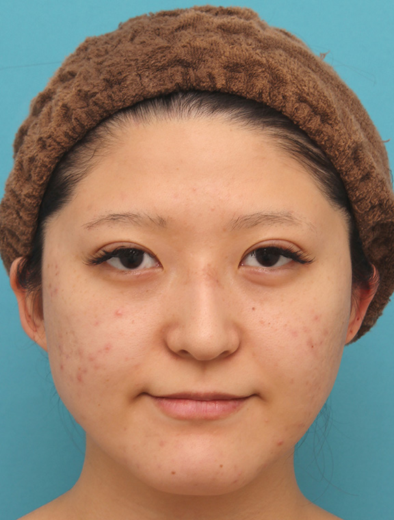 バッカルファット除去で小顔になった20代女性の症例写真,Before,ba_buccalfat017_b01.jpg