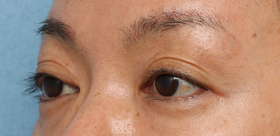 症例写真,上まぶたのくぼみ目ヒアルロン酸注射の症例写真,After（1ヶ月後）,ba_kubomi006_b02.jpg
