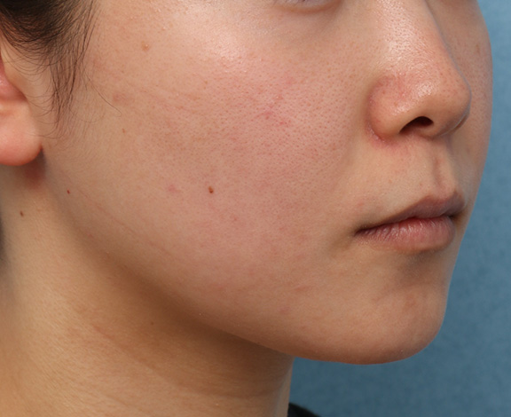 小顔専用脂肪溶解注射メソシェイプフェイス,メソシェイプフェイスの症例写真,After（3ヶ月後）,ba_meso_face013_b02.jpg