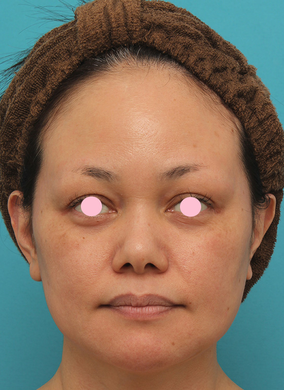 あご注射（ヒアルロン酸）,40代女性患者様に長期持続型ヒアルロン酸を2本（2cc）入れて顎を作った症例写真,After（2ヶ月後）,ba_agochu015_b01.jpg
