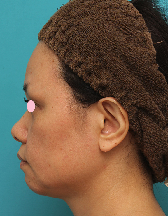 あご注射（ヒアルロン酸）,40代女性患者様に長期持続型ヒアルロン酸を2本（2cc）入れて顎を作った症例写真,Before,ba_agochu015_b02.jpg