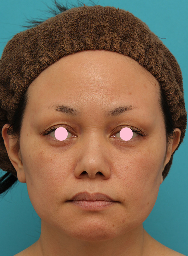 あご注射（ヒアルロン酸）,40代女性患者様に長期持続型ヒアルロン酸を2本（2cc）入れて顎を作った症例写真,注射前,mainpic_agochu015a.jpg