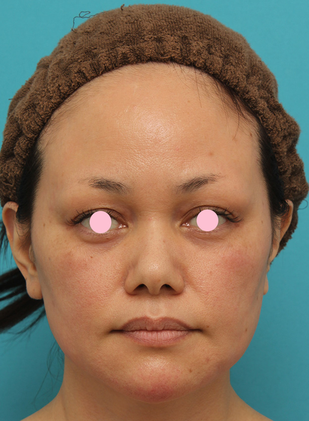 あご注射（ヒアルロン酸）,40代女性患者様に長期持続型ヒアルロン酸を2本（2cc）入れて顎を作った症例写真,注射直後,mainpic_agochu015b.jpg