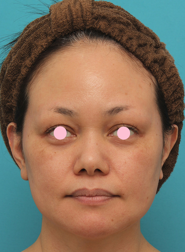 あご注射（ヒアルロン酸）,40代女性患者様に長期持続型ヒアルロン酸を2本（2cc）入れて顎を作った症例写真,2ヶ月後,mainpic_agochu015c.jpg