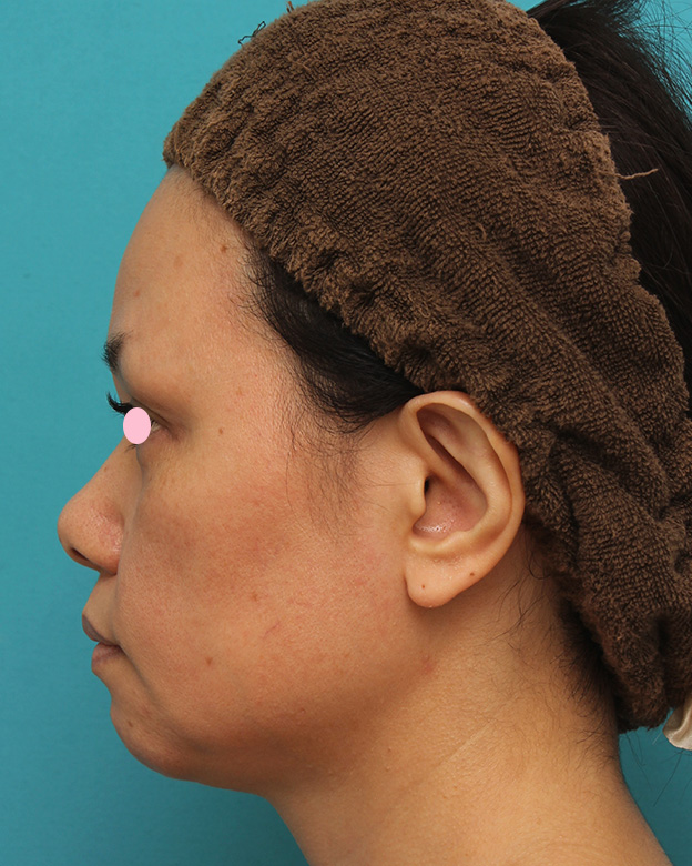 あご注射（ヒアルロン酸）,40代女性患者様に長期持続型ヒアルロン酸を2本（2cc）入れて顎を作った症例写真,注射前,mainpic_agochu015d.jpg