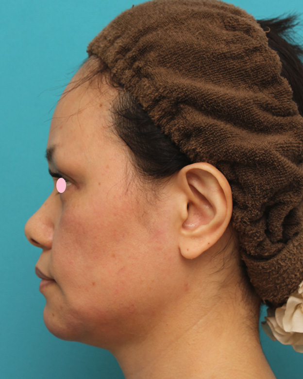 あご注射（ヒアルロン酸）,40代女性患者様に長期持続型ヒアルロン酸を2本（2cc）入れて顎を作った症例写真,注射直後,mainpic_agochu015e.jpg