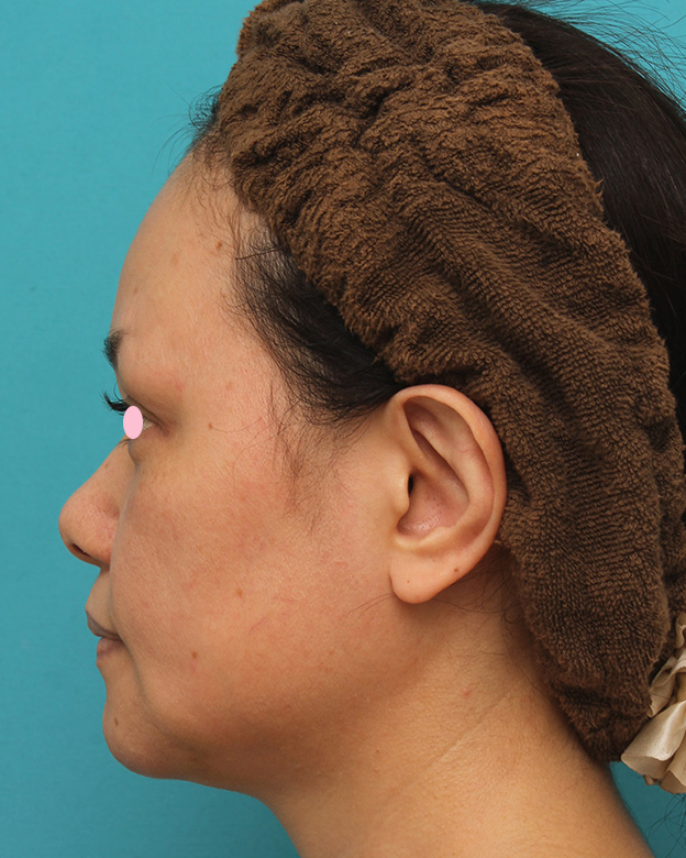 あご注射（ヒアルロン酸）,40代女性患者様に長期持続型ヒアルロン酸を2本（2cc）入れて顎を作った症例写真,2ヶ月後,mainpic_agochu015f.jpg