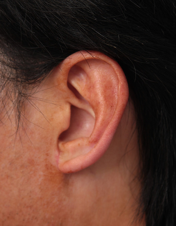 その他の耳の手術,大きな耳たぶを縮小手術で小さくした症例写真,After（1ヶ月後）,ba_other009_b01.jpg