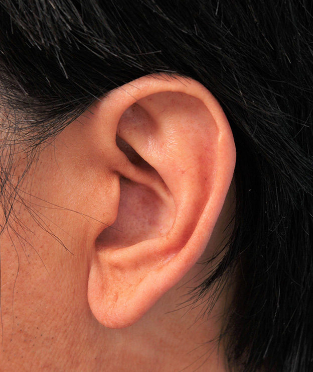 その他の耳の手術,大きな耳たぶを縮小手術で小さくした症例写真,手術前,mainpic_other009a.jpg