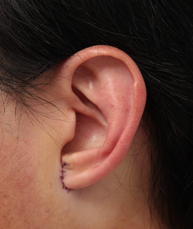 その他の耳の手術,大きな耳たぶを縮小手術で小さくした症例写真,手術直後,mainpic_other009b.jpg