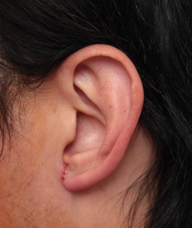 その他の耳の手術,大きな耳たぶを縮小手術で小さくした症例写真,1週間後,mainpic_other009c.jpg