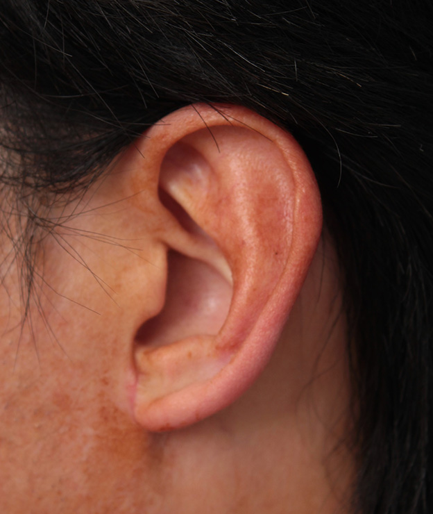 その他の耳の手術,大きな耳たぶを縮小手術で小さくした症例写真,1ヶ月後,mainpic_other009d.jpg