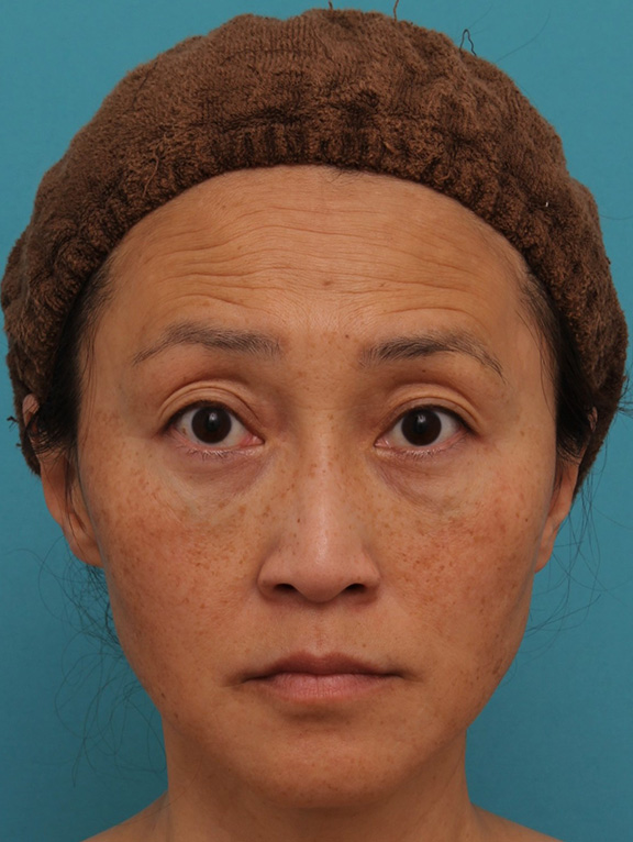 ゴルゴライン,40代女性の目の下をスッキリさせた症例写真,After（6ヶ月後）,ba_shibo_under013_b01.jpg