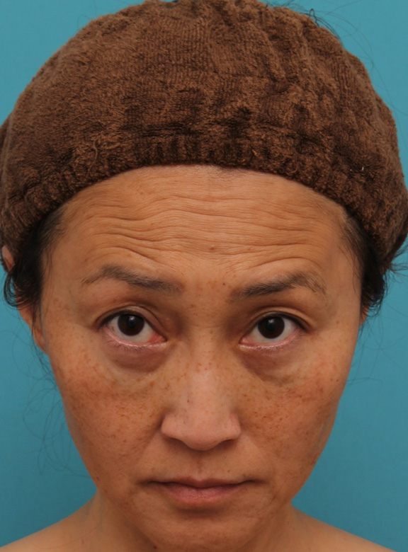 ゴルゴライン,40代女性の目の下をスッキリさせた症例写真,After（6ヶ月後）,ba_shibo_under013_b02.jpg