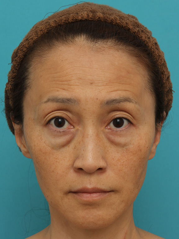目の下の脂肪取り,40代女性の目の下をスッキリさせた症例写真,Before,ba_shibo_under013_b01.jpg