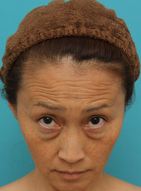 目の下の脂肪取り,40代女性の目の下をスッキリさせた症例写真,Before,ba_shibo_under013_b02.jpg